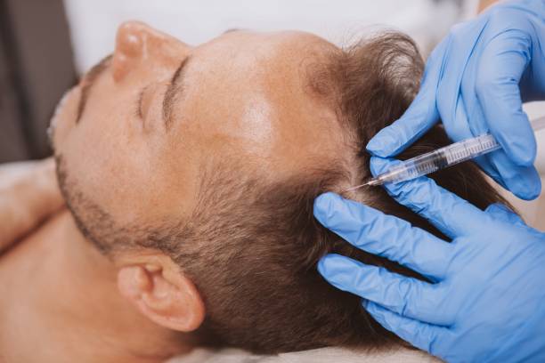 traitement chute des cheveux 